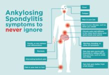 What Is Ankylosing Spondylitis (AS)? Symptoms, Causes, Diagnosis, and Treatment