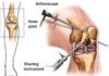 What Is Arthroscopy?