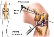 What Is Arthroscopy?