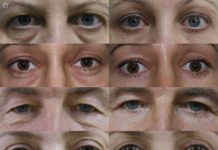 What Is Blepharoplasty?