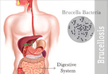 What Is Brucellosis? Symptoms, Causes, Diagnosis, Treatment, and Prevention