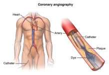 What Is Cardiac Catheterization?