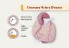What Is Coronary Artery Disease (CAD)?