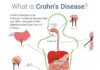 What Is Crohn’s Disease? Symptoms, Causes, Diagnosis, Treatment, and Prevention