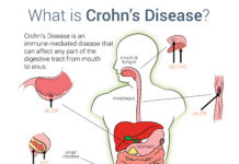 What Is Crohn’s Disease? Symptoms, Causes, Diagnosis, Treatment, and Prevention