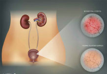 What Is Cystitis? Symptoms, Causes, Diagnosis, Treatment, and Prevention