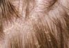 What Is Dandruff? Symptoms, Causes, Diagnosis, Treatment, and Prevention