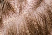What Is Dandruff? Symptoms, Causes, Diagnosis, Treatment, and Prevention
