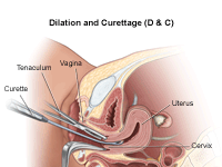 What Is Dilation and Curettage (D&C)?
