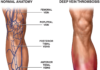 What Is DVT (Deep Vein Thrombosis)? Symptoms, Causes, Diagnosis, Treatment, and Prevention