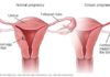 What Is Ectopic Pregnancy? Symptoms, Causes, Diagnosis, Treatment, and Prevention