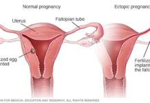What Is Ectopic Pregnancy? Symptoms, Causes, Diagnosis, Treatment, and Prevention