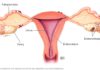 What Is Endometriosis? Symptoms, Causes, Diagnosis, Treatment, and Prevention