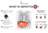 What Is Hepatitis A? Symptoms, Causes, Diagnosis, Treatment, and Prevention