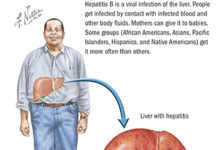 What Is Hepatitis B? Symptoms, Causes, Diagnosis, Treatment, and Prevention