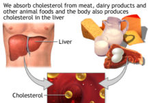 What Is High Cholesterol? Symptoms, Causes, Diagnosis, Treatment, and Prevention