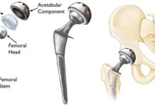 What Is Hip Replacement?
