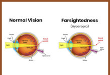 What Is Hyperopia (Farsightedness)? Symptoms, Causes, Diagnosis, Treatment, and Prevention