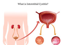 What Is Interstitial Cystitis? Symptoms, Causes, Diagnosis, Treatment, and Prevention