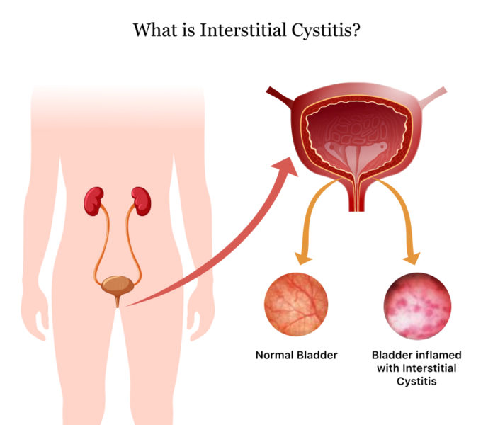 what-is-interstitial-cystitis-symptoms-causes-diagnosis-treatment-and-prevention