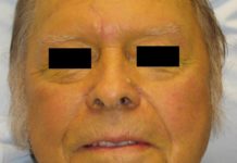 What Is Jaundice? Symptoms, Causes, Diagnosis, Treatment, and Prevention