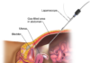 What Is Laparoscopy?