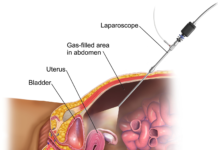 What Is Laparoscopy?