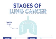 What Is Lung Cancer? Symptoms, Causes, Diagnosis, Treatment, and Prevention
