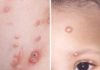 What Is Molluscum Contagiosum? Symptoms, Causes, Diagnosis, Treatment, and Prevention