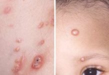 What Is Molluscum Contagiosum? Symptoms, Causes, Diagnosis, Treatment, and Prevention
