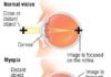 What Is Myopia (Nearsightedness)? Symptoms, Causes, Diagnosis, Treatment, and Prevention
