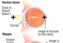 What Is Myopia (Nearsightedness)? Symptoms, Causes, Diagnosis, Treatment, and Prevention