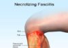 What Is Necrotizing Fasciitis?