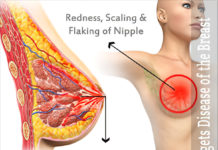 What Is Paget Disease of the Breast?