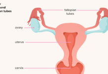 What Is Pelvic Inflammatory Disease (PID)? Symptoms, Causes, Diagnosis, Treatment, and Prevention