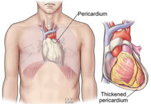 What Is Pericarditis? Symptoms, Causes, Diagnosis, Treatment, and Prevention
