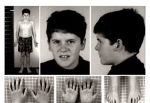 What Is Prader-Willi Syndrome?