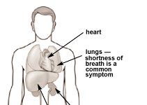 What Is Pulmonary Hypertension? Symptoms, Causes, Diagnosis, Treatment, and Prevention
