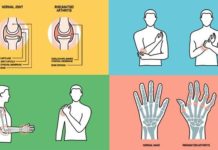 What Is Rheumatoid Arthritis? Symptoms, Causes, Diagnosis, Treatment, and Prevention