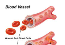 What Is Sickle Cell Anemia? Symptoms, Causes, Diagnosis, Treatment, and Prevention