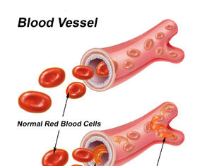 What Is Sickle Cell Anemia? Symptoms, Causes, Diagnosis, Treatment, and Prevention