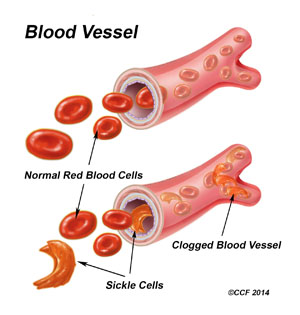 what-is-sickle-cell-anemia-symptoms-causes-diagnosis-treatment-and-prevention