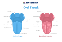 What Is Thrush? Symptoms, Causes, Diagnosis, Treatment, and Prevention