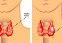 What Is Thyroid Cancer? Symptoms, Causes, Diagnosis, Treatment, and Prevention