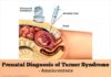 What Is Turner Syndrome? Symptoms, Causes, Diagnosis, Treatment, and Prevention