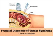 What Is Turner Syndrome? Symptoms, Causes, Diagnosis, Treatment, and Prevention