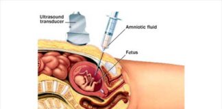 What Is Turner Syndrome? Symptoms, Causes, Diagnosis, Treatment, and Prevention