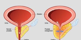 What Is Urinary Incontinence? Symptoms, Causes, Diagnosis, Treatment, and Prevention