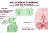 What Is Wallenberg Syndrome? Symptoms, Causes, Diagnosis, Treatment, and Prevention