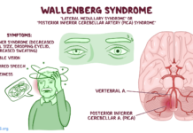 What Is Wallenberg Syndrome? Symptoms, Causes, Diagnosis, Treatment, and Prevention